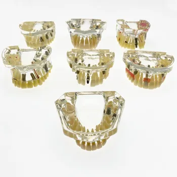 Köprü ve çürük ile diş modeli Üst Çene Alt Çene Diş modeli Diş implant modeli